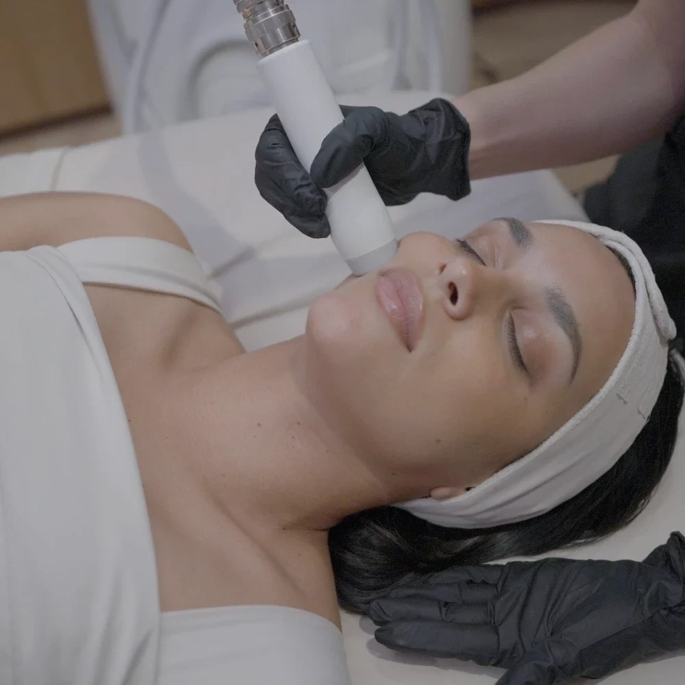 T-Shape 2 facial treatment on the cheek at iCRYO South Jordan